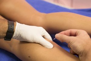 dry needling 